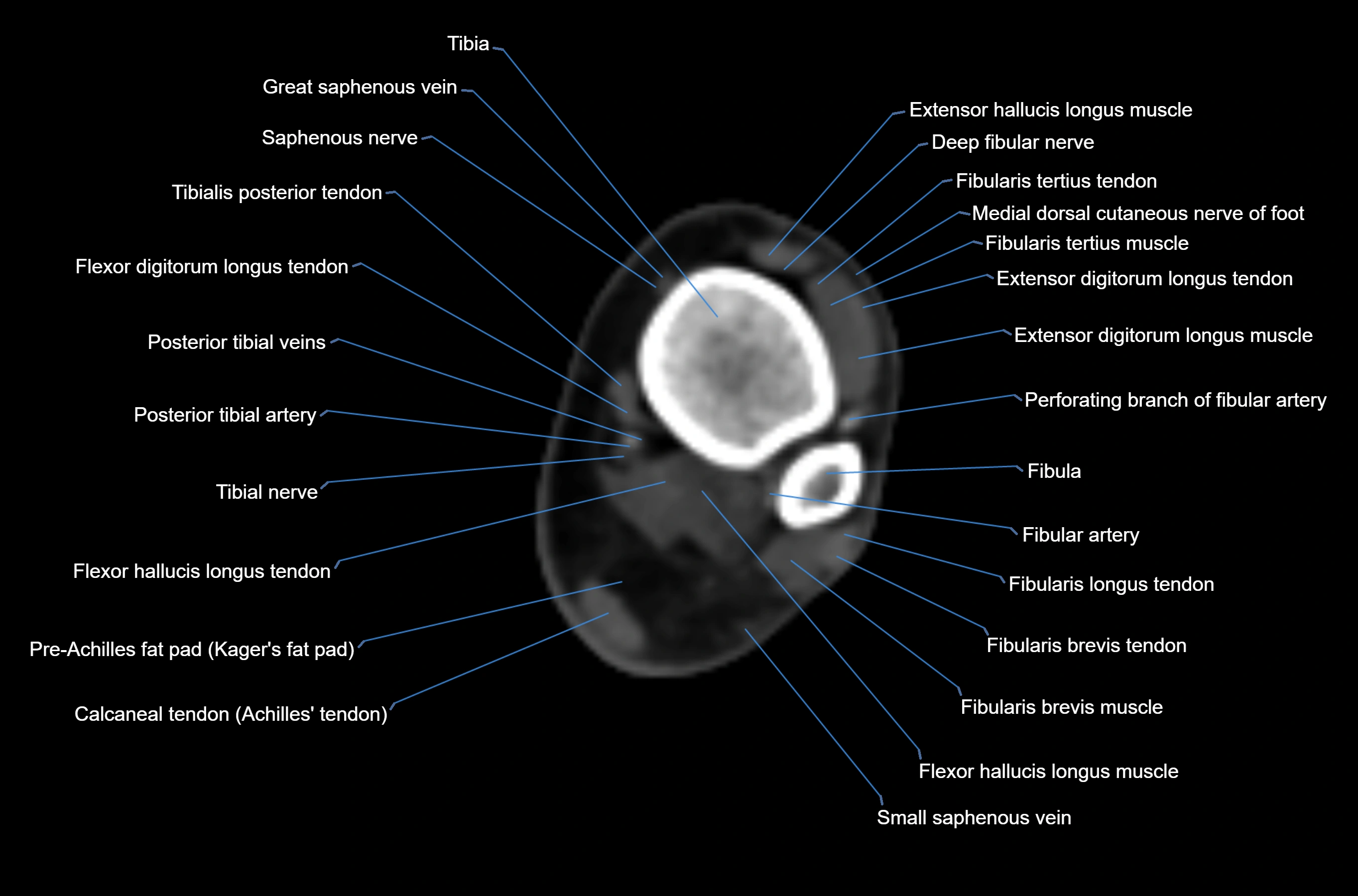 CT Ankle axial cross sectional anatomy labelled image -00021.webp